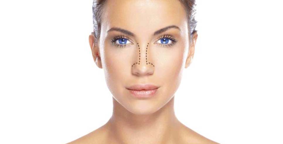 Rinoplastia